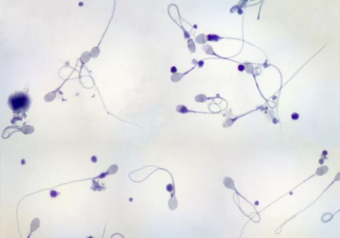 Oligozoospermi tanısı kondu - az sayıda sperm